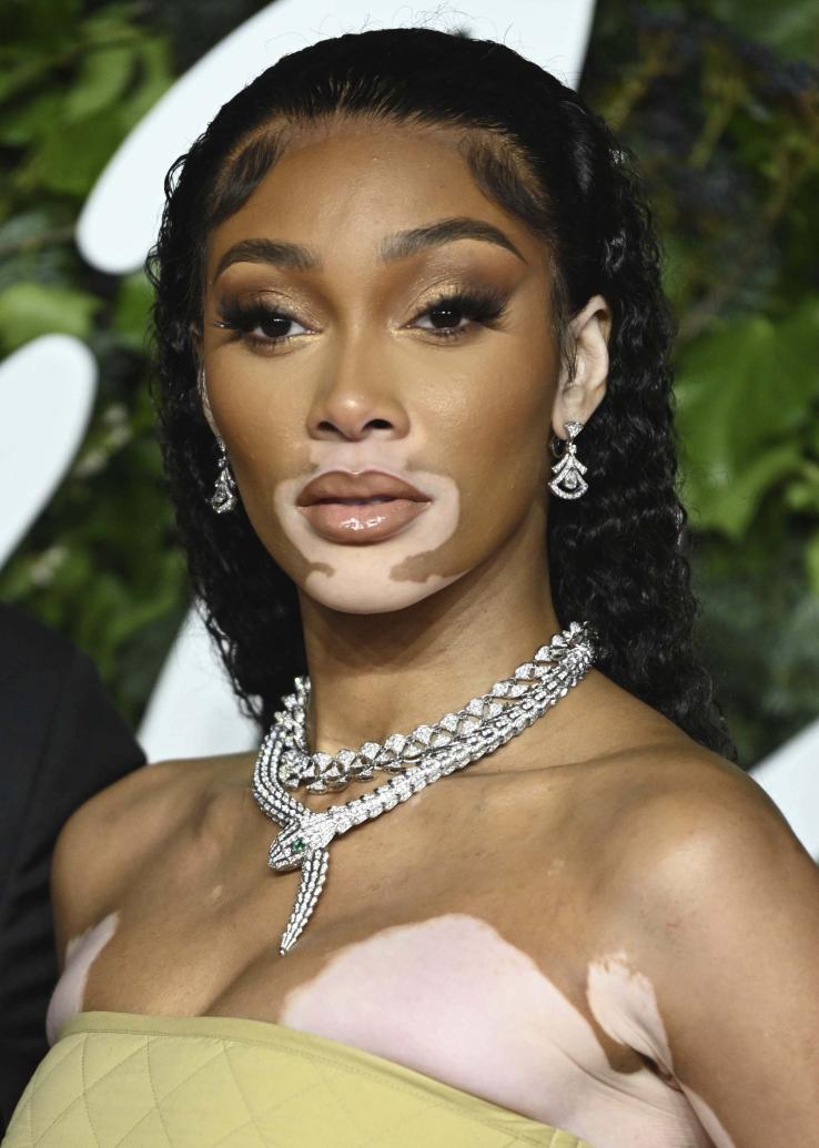 Canadian fashion model Winnie Harlow, seen here in London for the 2021 British Fashion Awards, is one of several celebrities who have been outspoken about their vitilago.